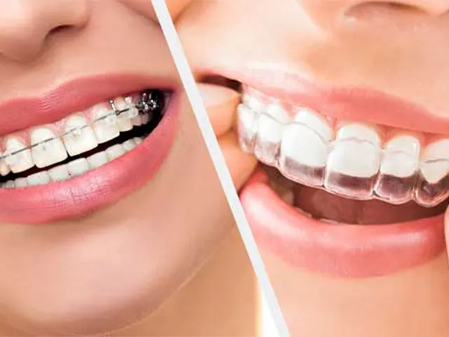مراحل، قیمت ارتودنسی نامرئی و انواع آن