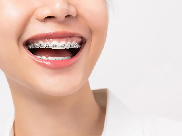 انواع ارتودنسی دندان