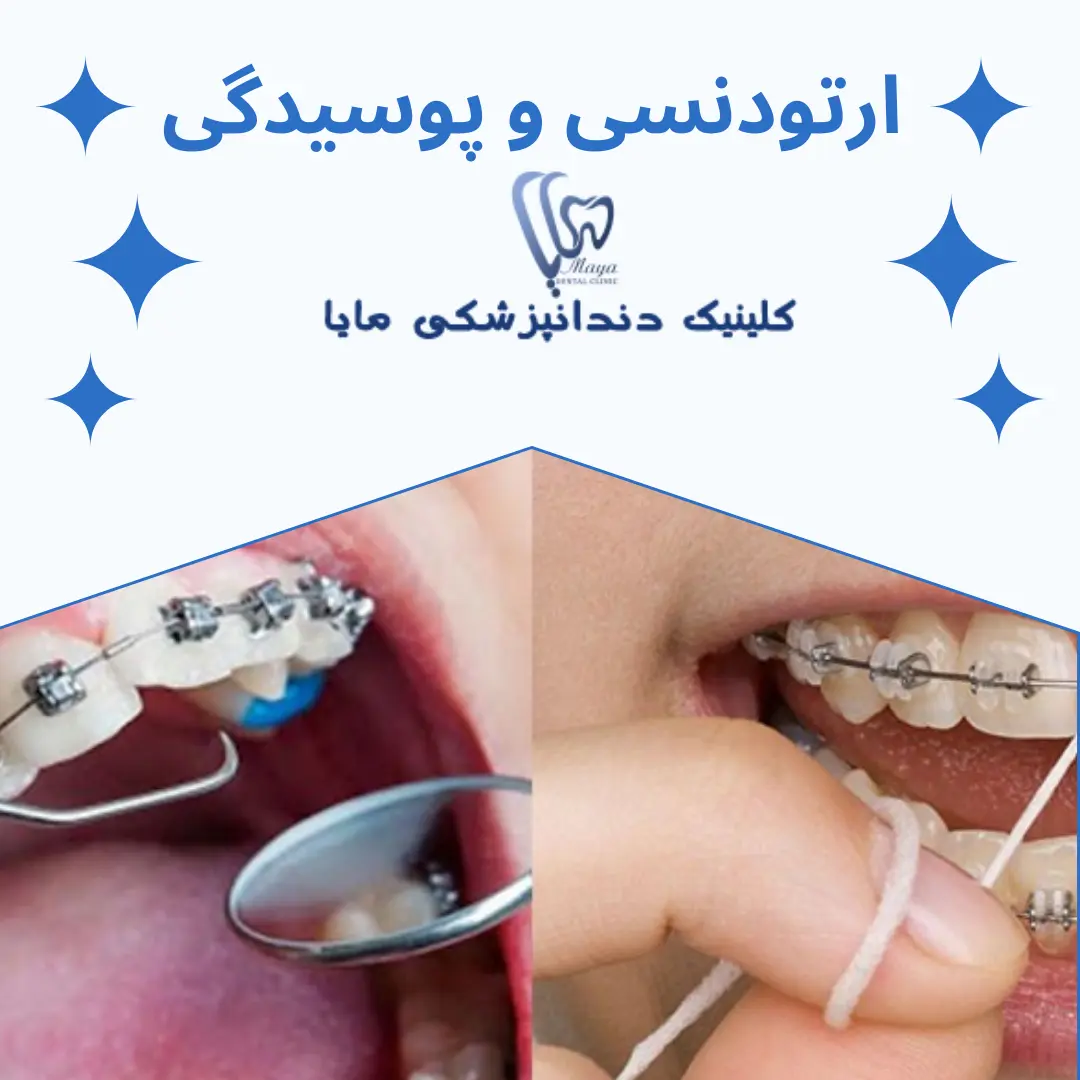 ارتودنسی سبب پوسیدگی دندان می‌شود؟