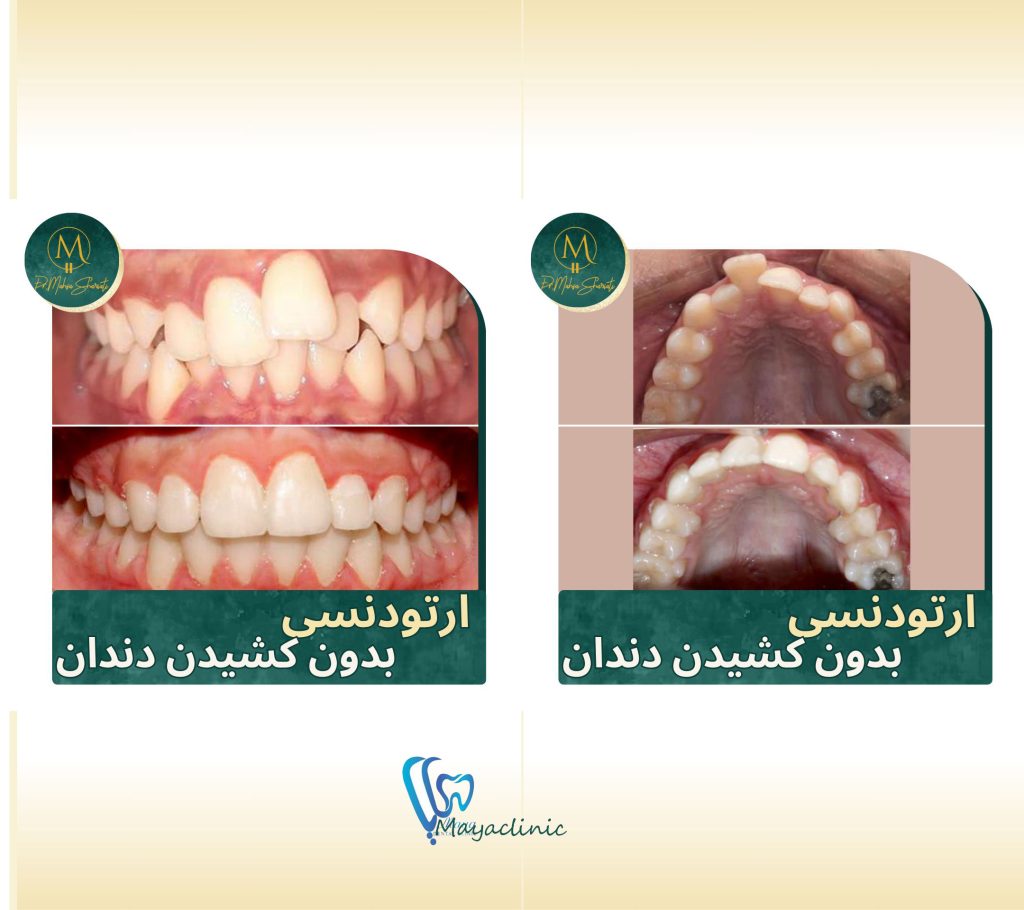 ارتودنسی دندان چقد طول میکشه؟