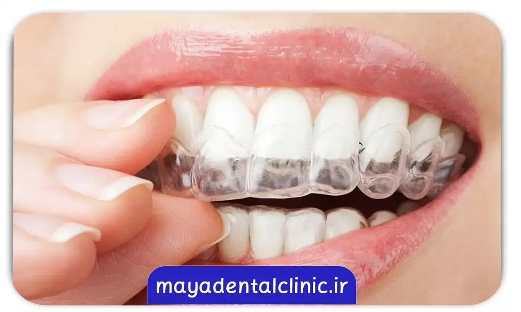 نگهدارنده ارتودنسی متحرک
