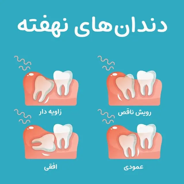 impaction tooth