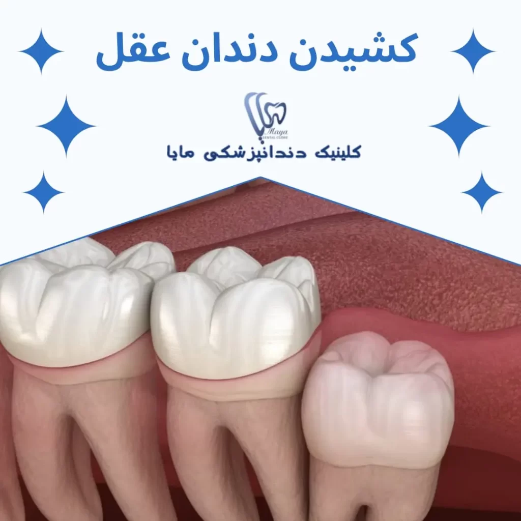 کشیدن دندان عقل برای ارتودنسی