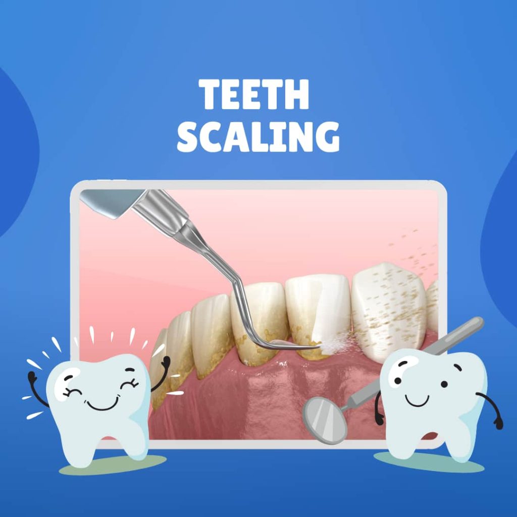 Teeth Scaling