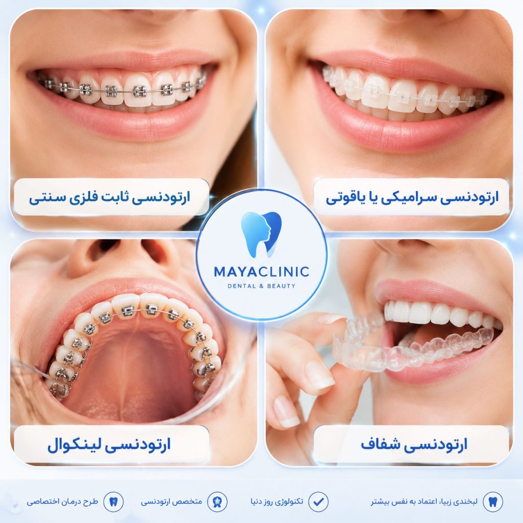 قیمت انواع ارتودنسی دندان