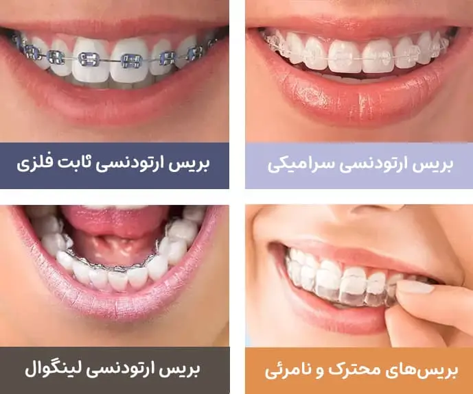 انواع بریس