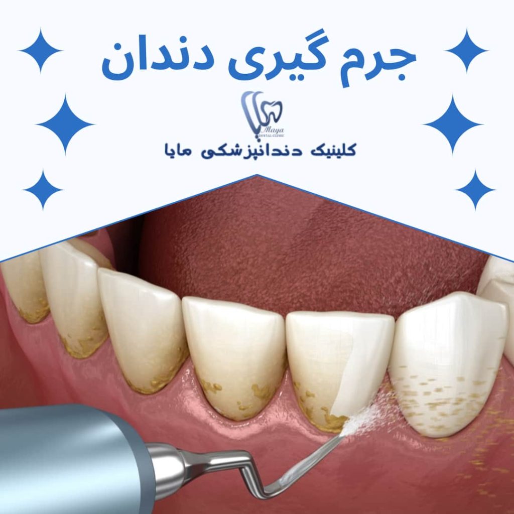 جرم گیری از دندان مضر است؟