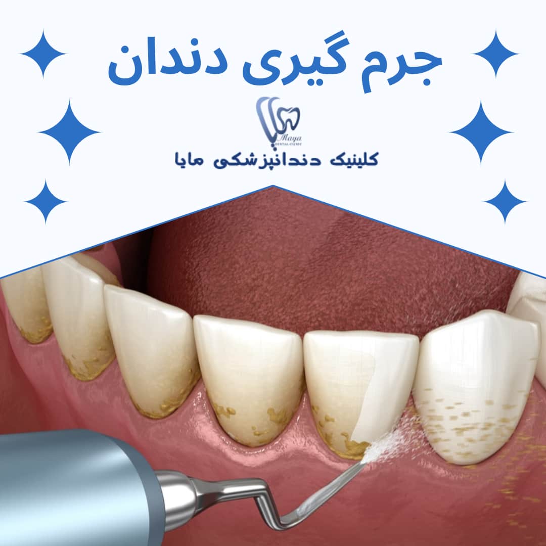 جرم گیری از دندان مضر است؟