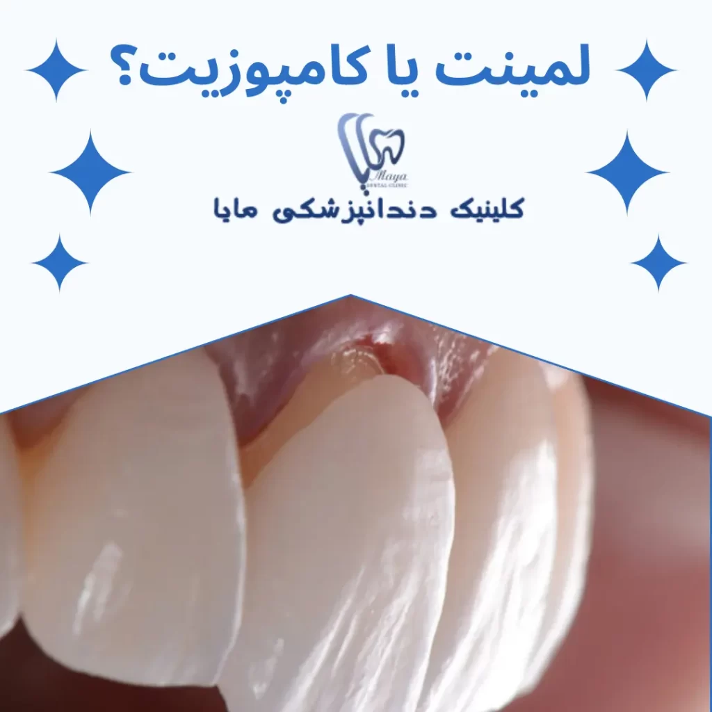 تفاوت کامپوزیت و لمینت