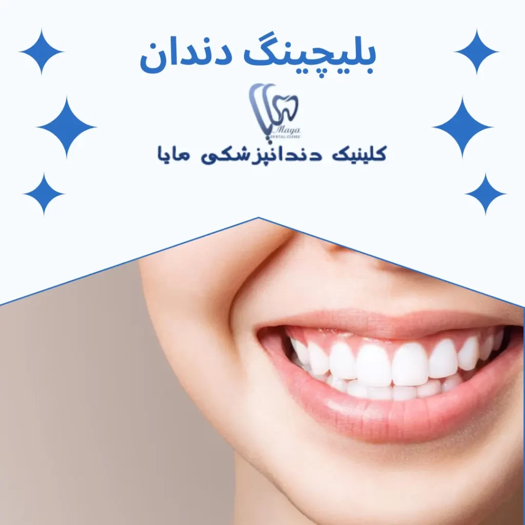 بلیچینگ دندان چیست