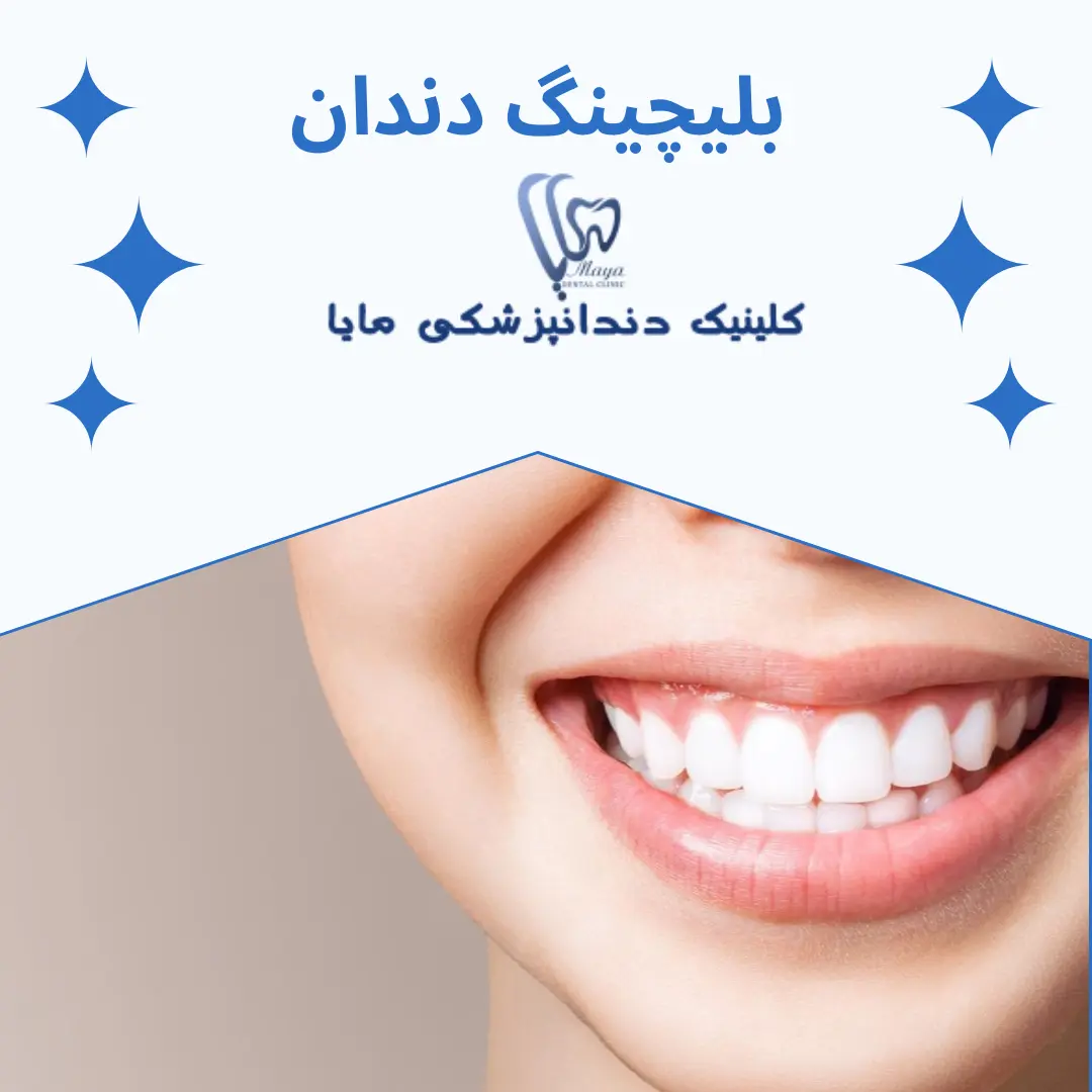 بلیچینگ دندان چیست