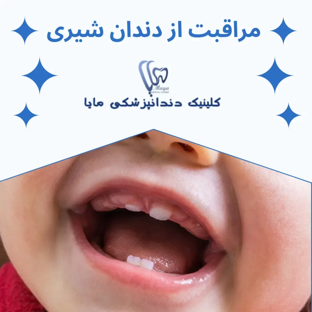 مراقبت از دندان شیری