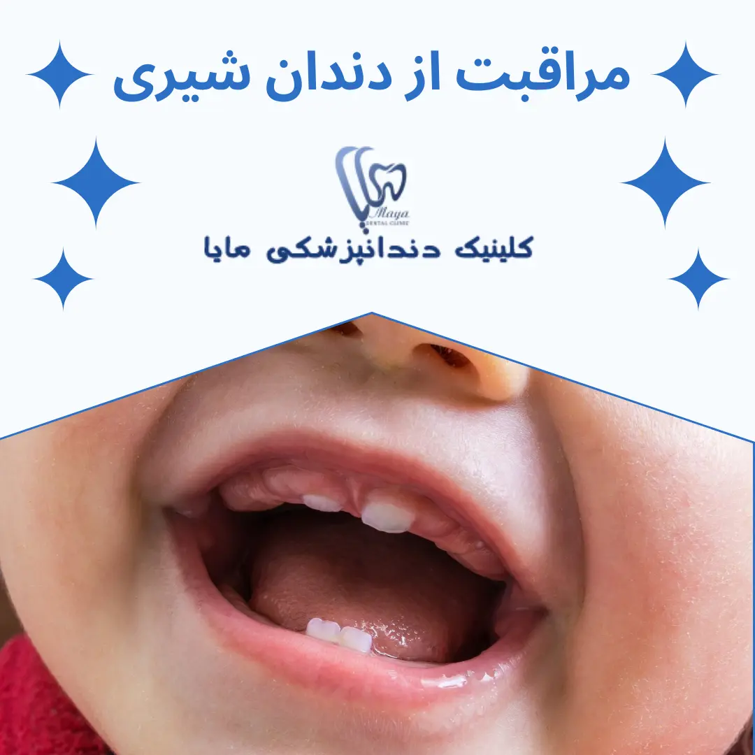 مراقبت از دندان شیری