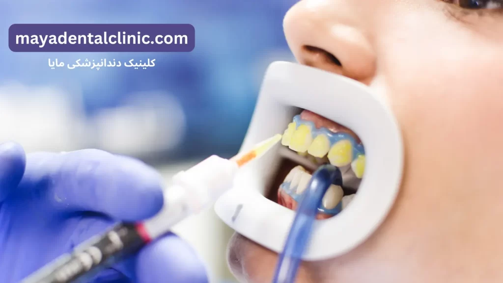Female patient on teeth bleaching treatment