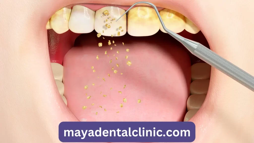 Tartar removal in human teeth by conventional periodontal using dental tools