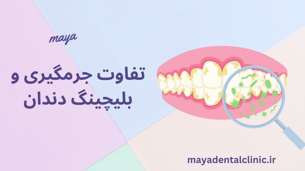 تفاوت جرمگیری و بلیچینگ دندان