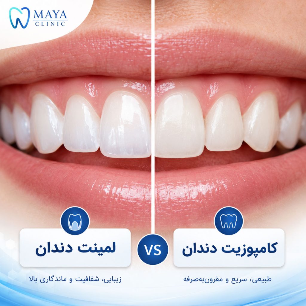 لمینت بهتره یا کامپوزیت