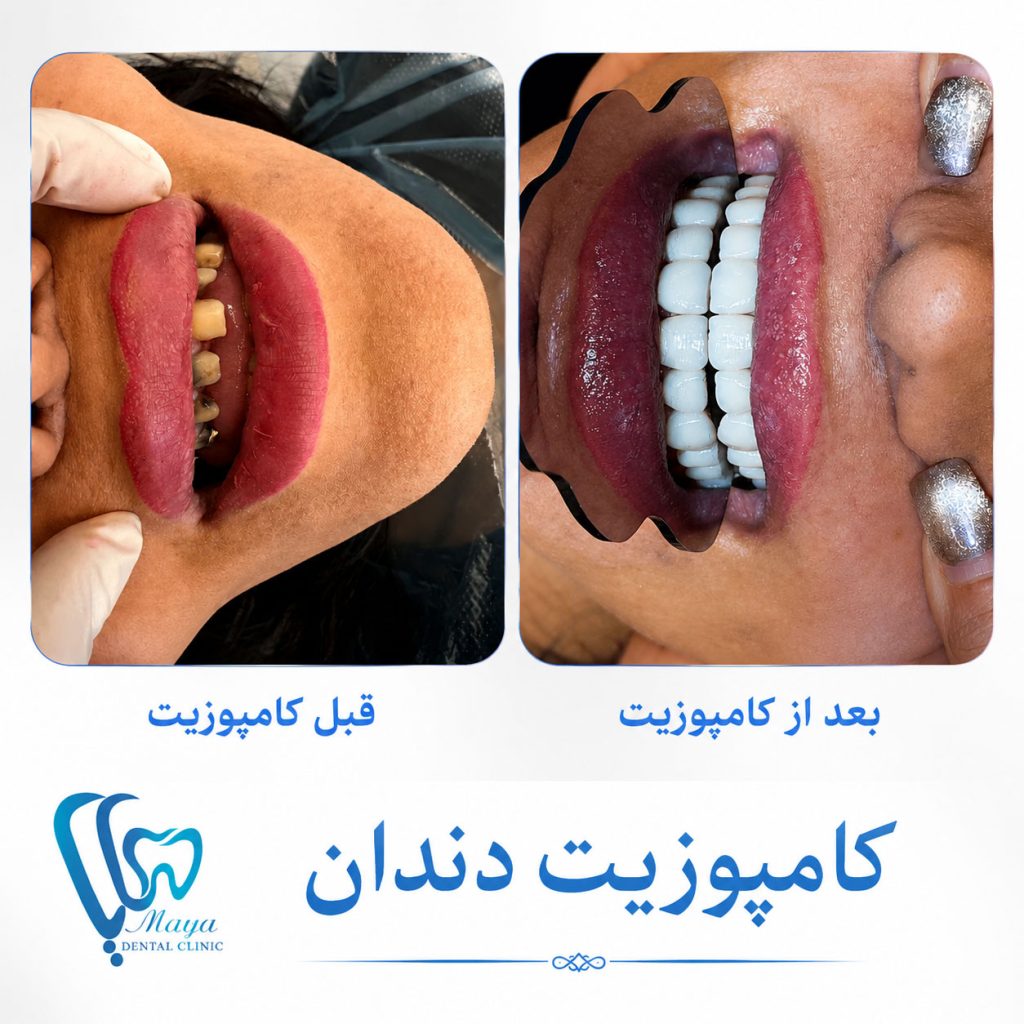 لمینت بهتر است یا کامپوزیت