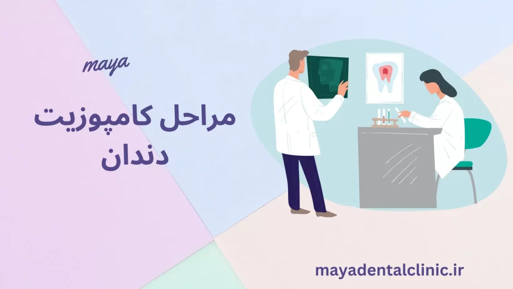 مراحل کامپوزیت دندان