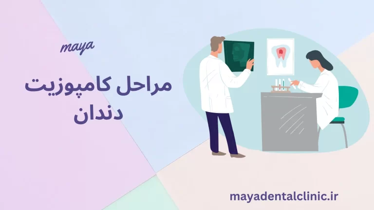 مراحل کامپوزیت دندان