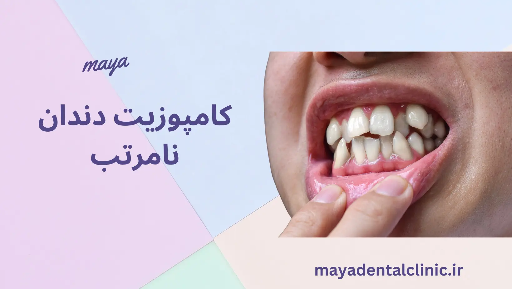 کامپوزیت دندان نامرتب و کج
