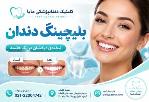 بلیچینگ دندان تهران