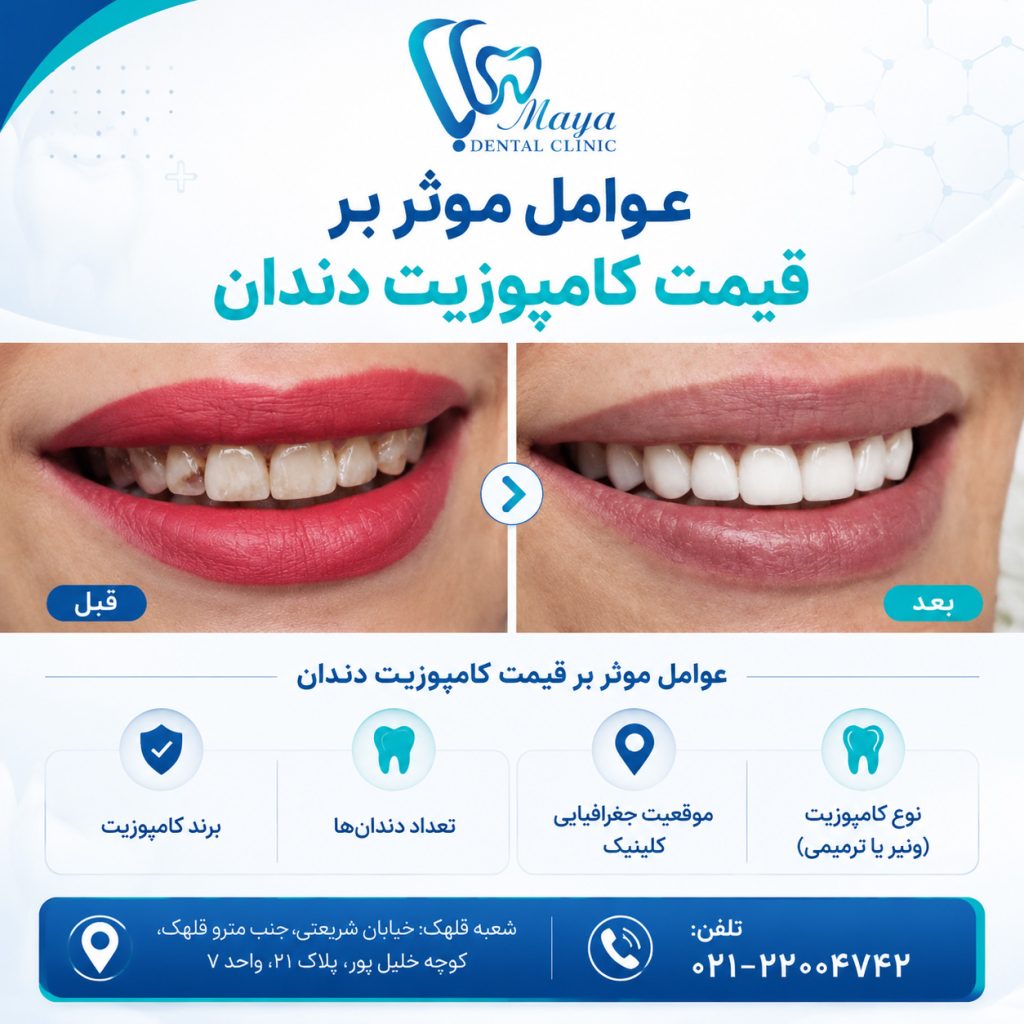 عوامل موثر بر قیمت کامپوزیت دندان