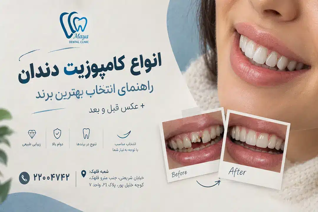 انواع کامپوزیت دندان، راهنمای انتخاب بهترین برند - کلینیک دندانپزشکی مایا
