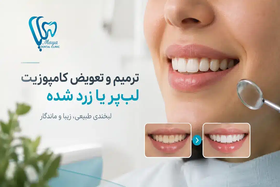 ترمیم و تعویض کامپوزیت لب‌پر یا زرد شده + هزینه ۱۴۰۵ کلینیک مایا شریعتی تهران