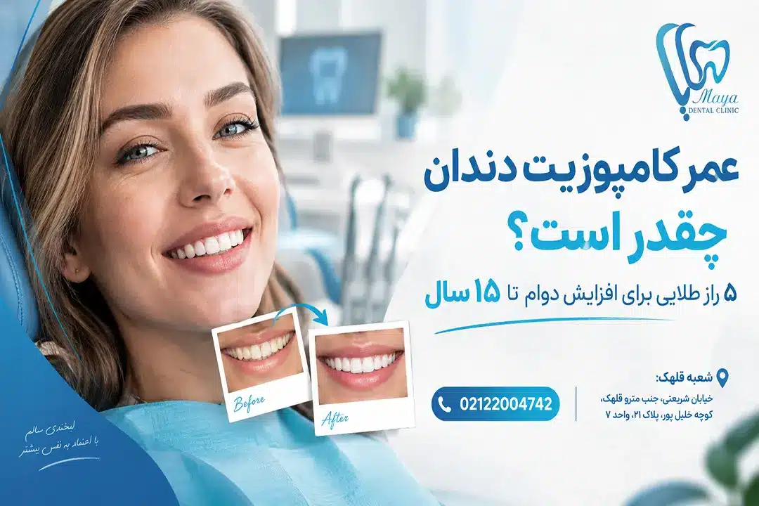 عمر کامپوزیت دندان چقدر است - کلینیک دندانپزشکی مایا